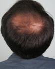 Before Hair Transplant &nbsp;Midscalp